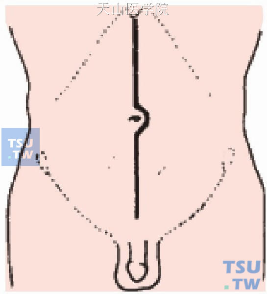 肾动脉水平以下的腹主动脉瘤取腹部正中切口，自剑突至耻骨联合