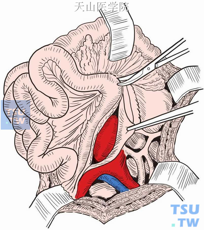 将大网膜和横结肠推向上方，小肠移向右上方
