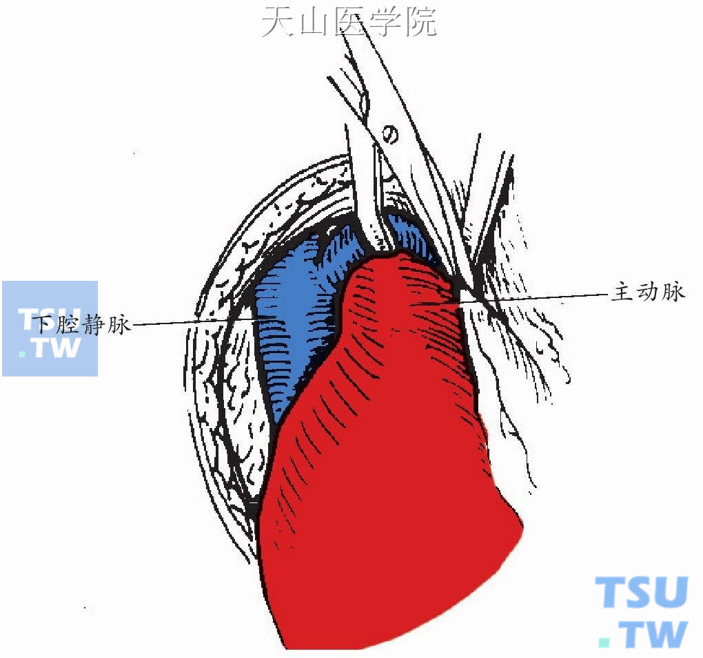 主动脉人造血管图片图片