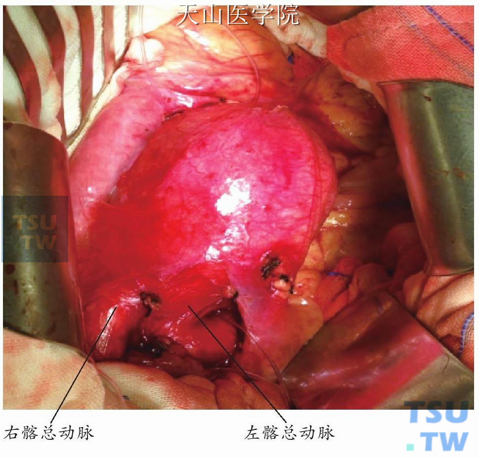 游离左右髂总动脉