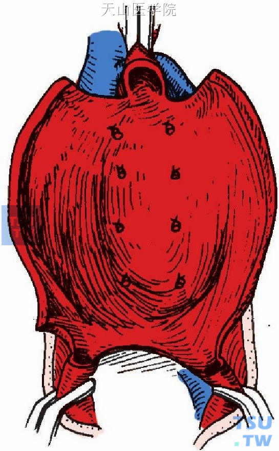 瘤颈部主动脉及两侧髂动脉做前半周环状切断