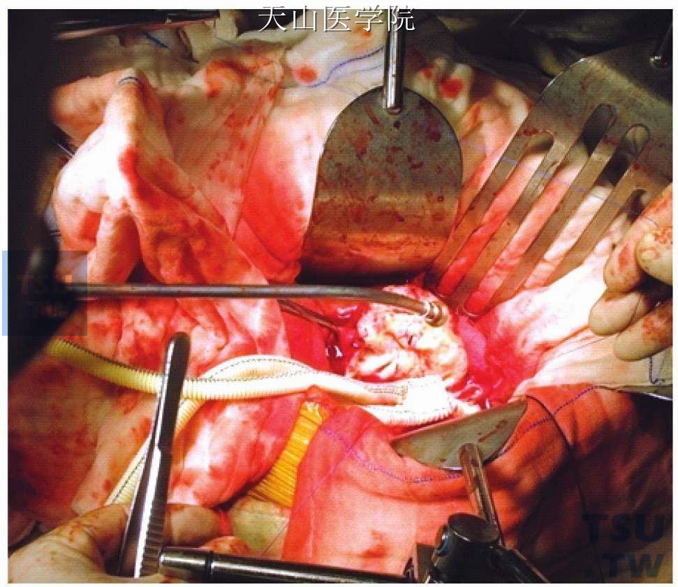 胸（腹）主动脉瘤切除人造血管移植术
