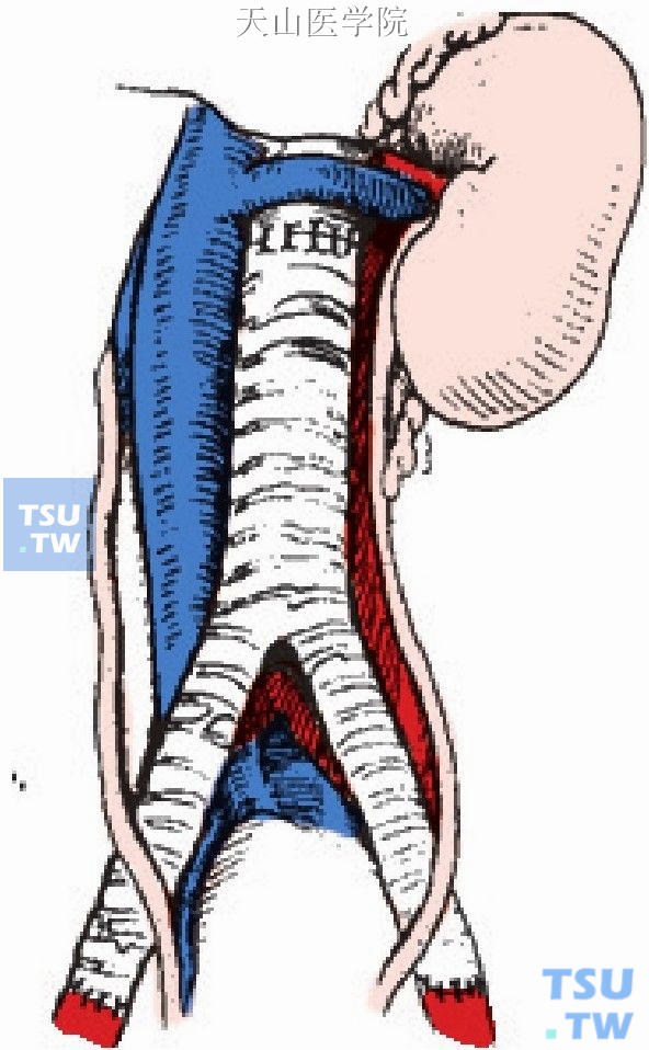 人造血管两臂经腹膜后与股动脉吻合