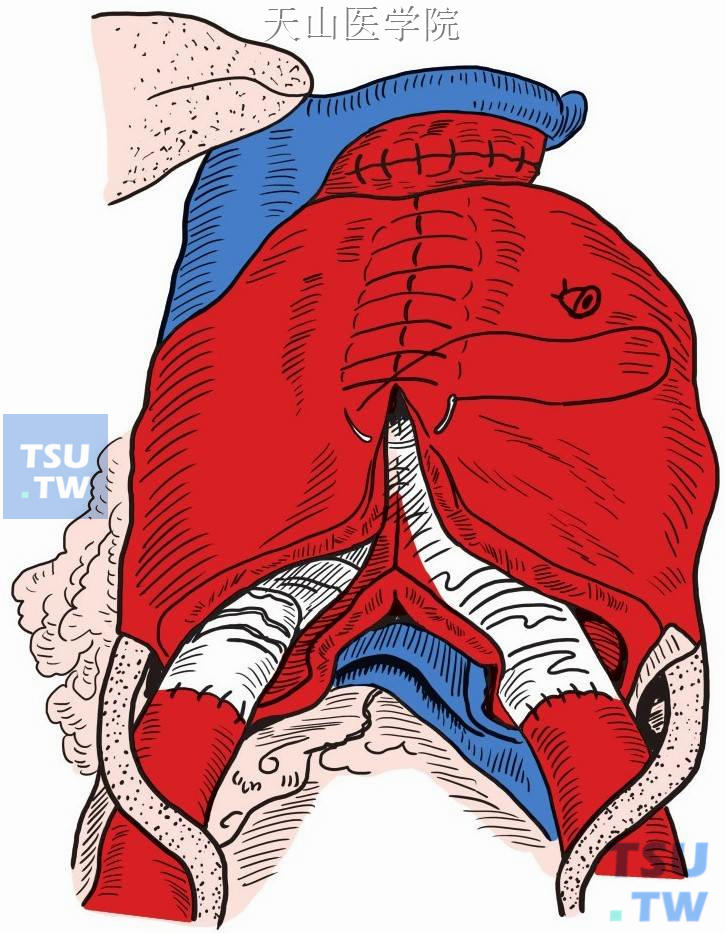 动脉瘤囊壁连续缝合包绕人造血管