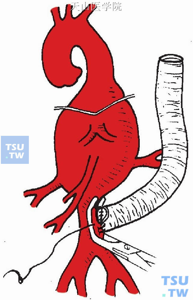人造血管吻合于远侧腹主动脉