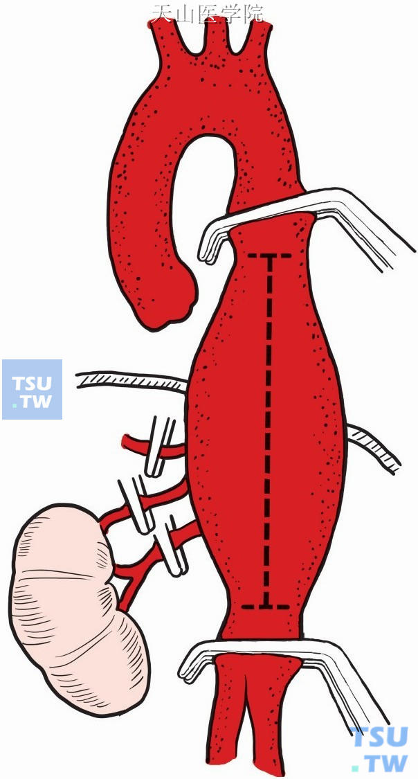 阻断瘤体近、远端主动脉及所累及内脏动脉各分支，纵行切开瘤体