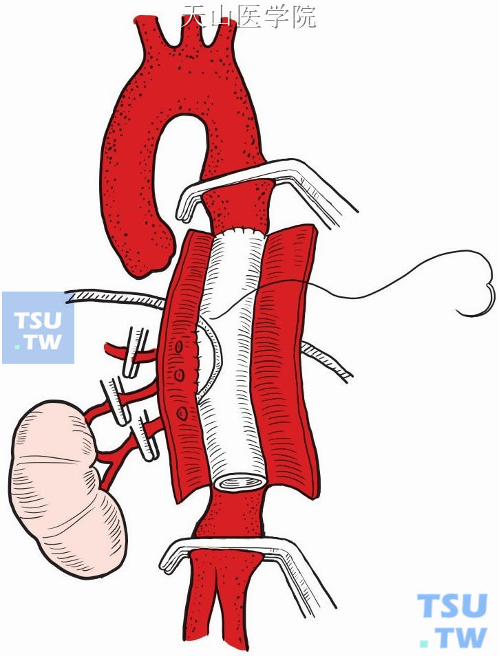 人造血管远端与腹主动脉端端吻合，残留壁包裹于人造血管外面