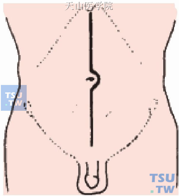 取从剑突下至耻骨联合上缘的腹部正中切口