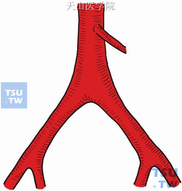 显露腹主动脉分叉部位及两侧髂动脉