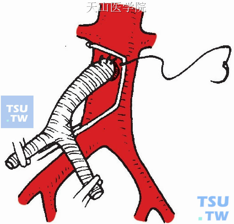 人造血管腹主动脉端侧吻合