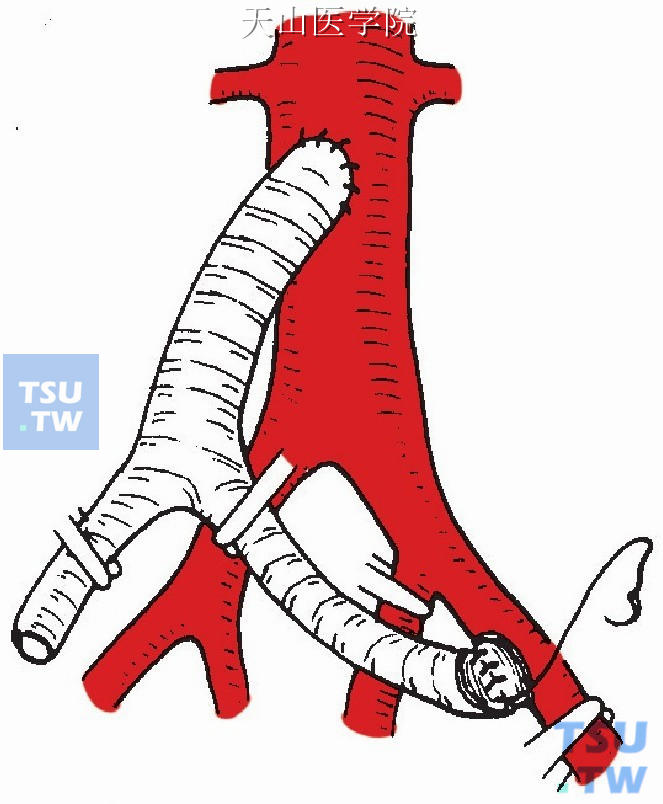 人造血管与髂动脉端侧吻合