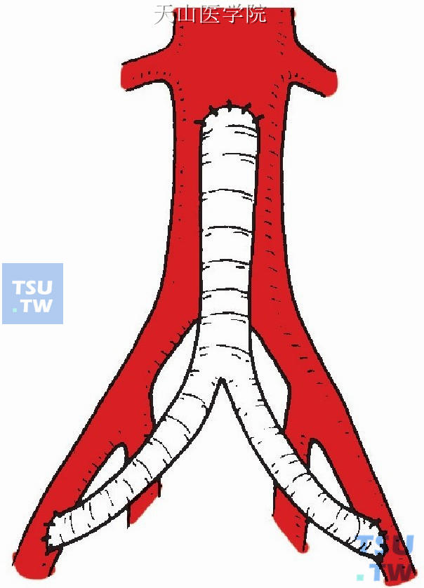 对侧人造血管髂动脉端侧吻合