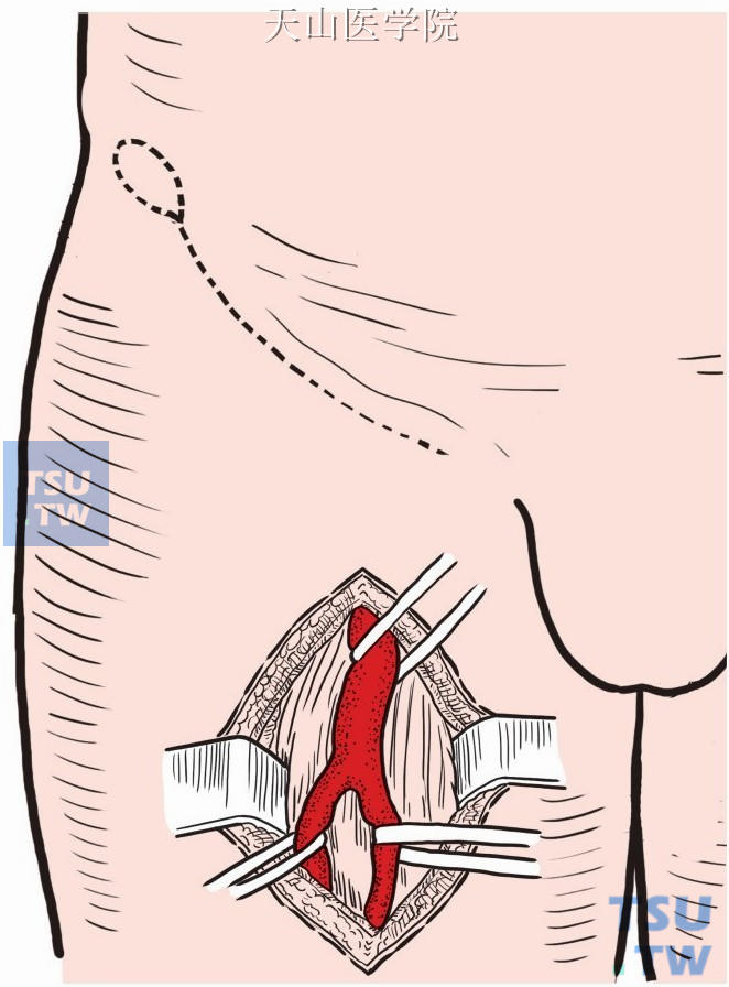 沿股动脉行径做切口，显露游离股总、股浅和股深动脉，塑料带控制血流