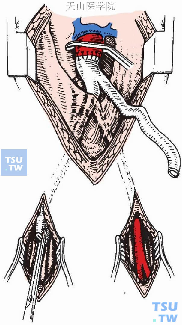 用血管钳沿隧道向上夹住分叉型人造血管一臂，并拖至腹股沟区切口