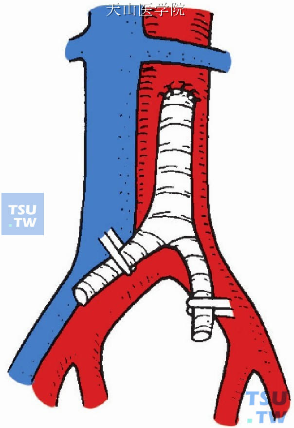 人造血管腹主动脉连续外翻端侧吻合