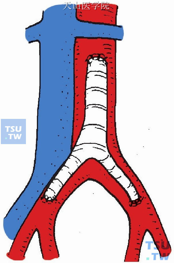 人造血管分叉两端与股总动脉完成端侧吻合