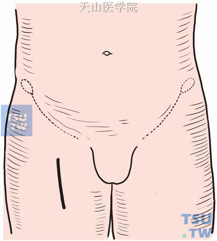 腹股沟区沿股动脉行径做8cm切口