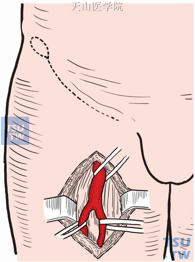 显露股总、股浅、股深动脉，分别用塑料带控制血流