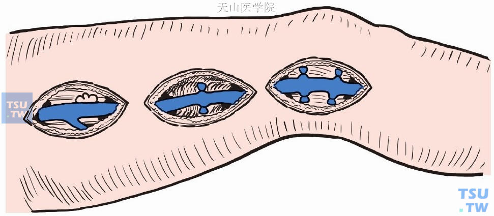 大腿中段另做切口，游离大隐静脉并沿途切断结扎分支