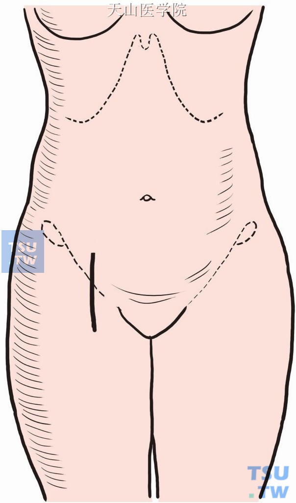 在腹股沟区沿股动脉行径做切口约长8cm