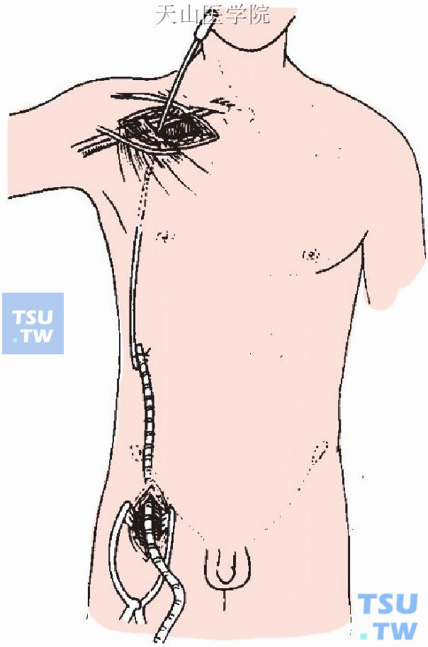 腋部至股部造皮下隧道