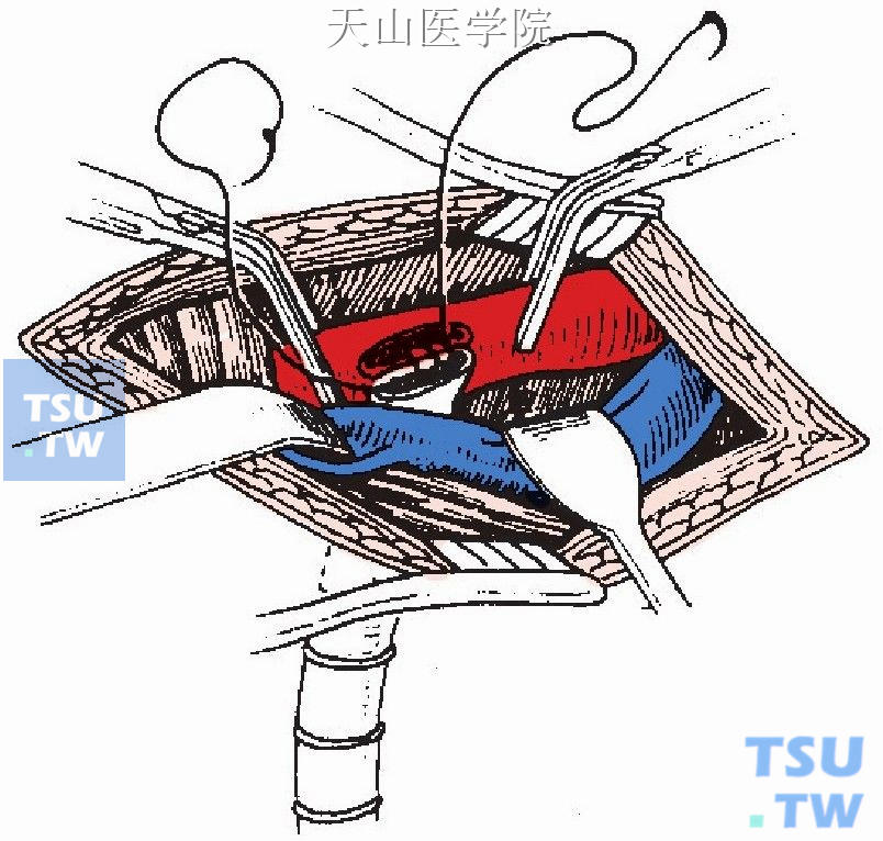 人造血管腋动脉端侧吻合