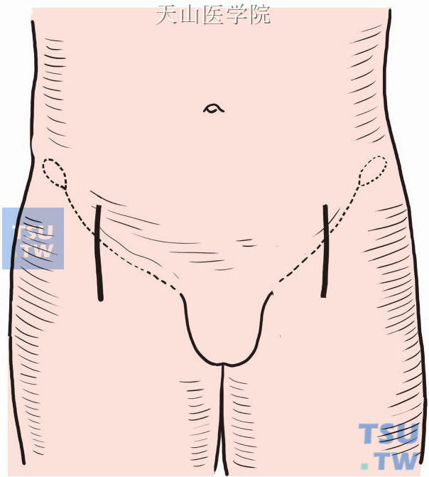 两侧腹股沟区沿股动脉行径做8cm长切口