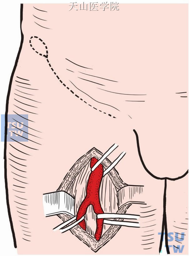 分别显露两侧股总、股浅和股深动脉，并用塑料带控制血流，以右侧为例
