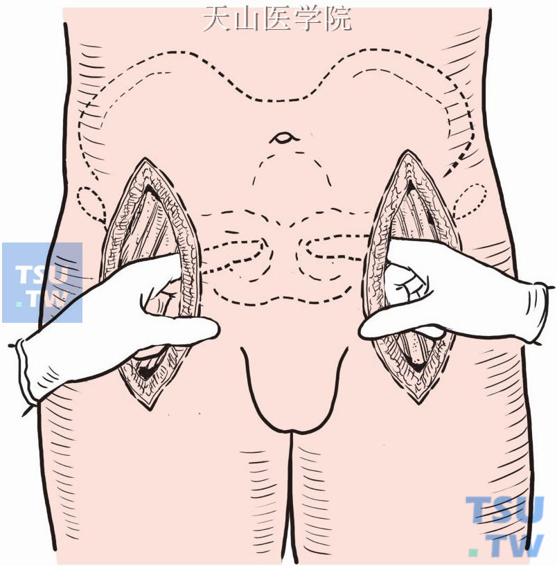 腹股沟韧带深面手指钝性分离成皮下隧道