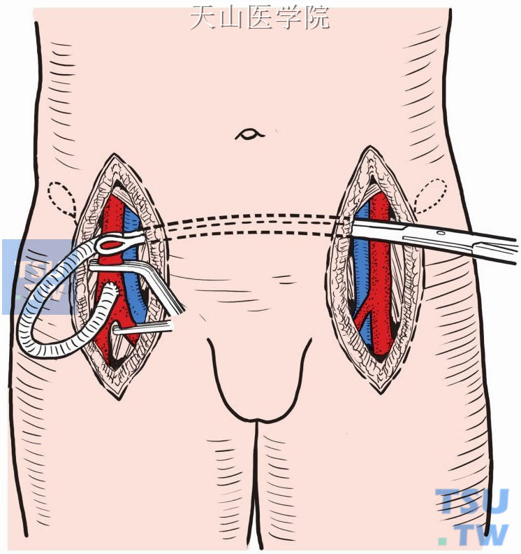 通过耻骨上皮下隧道将人造血管置入隧道内，从患侧腹股沟区切口引出