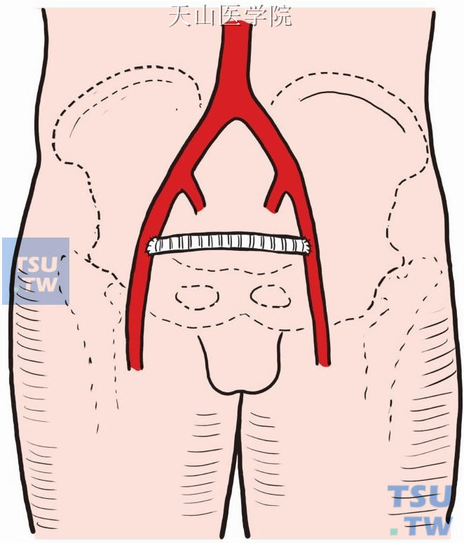 与患侧股总动脉由侧壁做连续外翻的端侧吻合