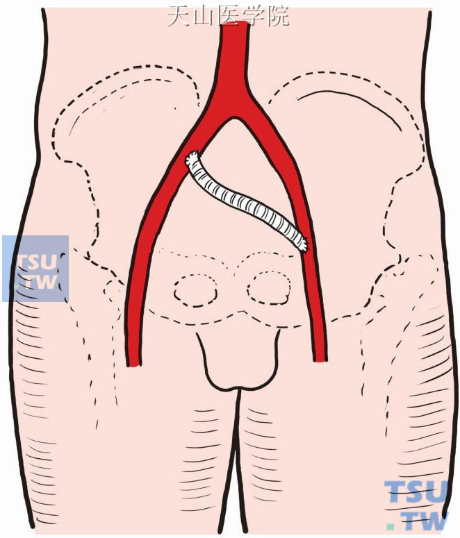髂外—股总动脉旁路术