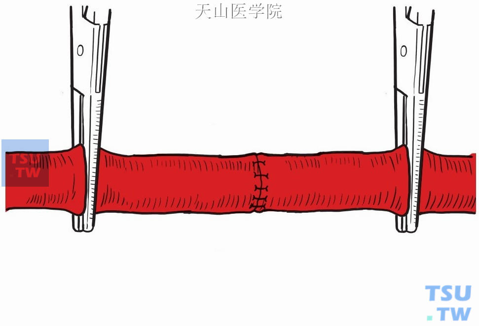 切除瘤体血管重建