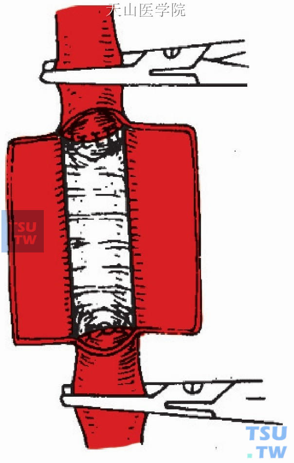 人造血管间置端端吻合