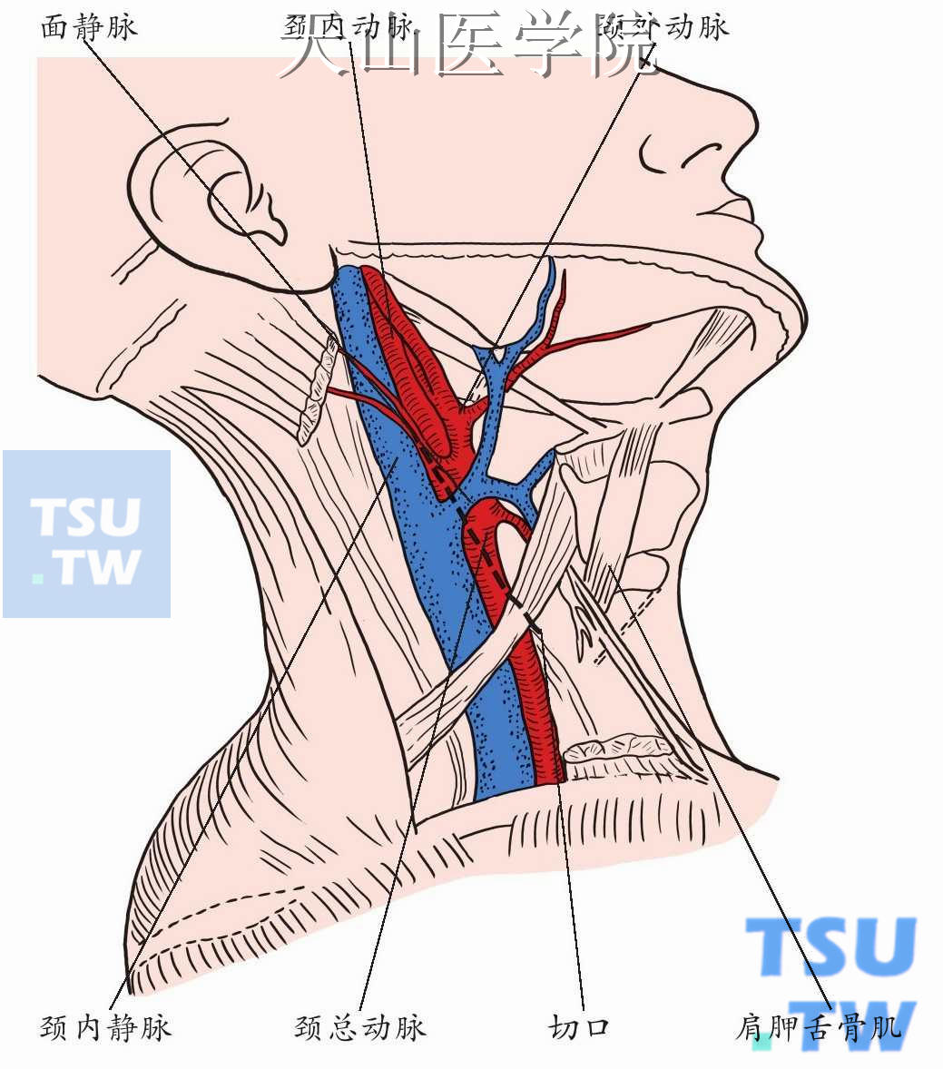 颈部切口选择，颈动脉鞘显露