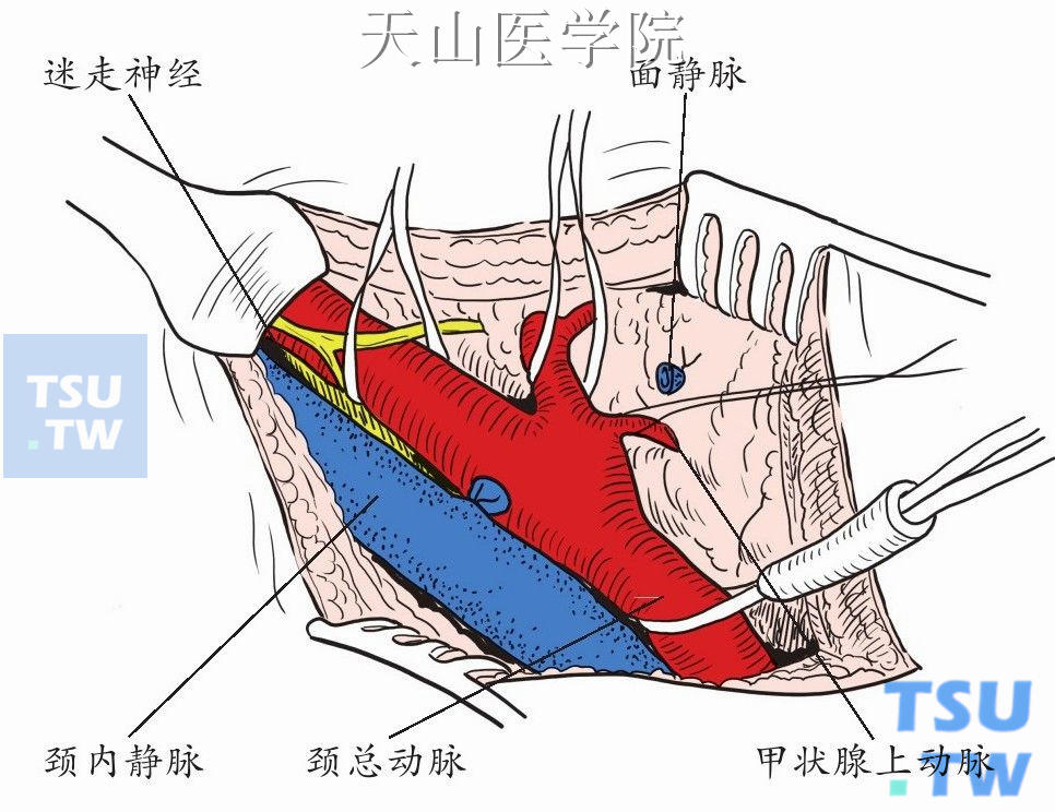 显露颈总、颈内和颈外动脉