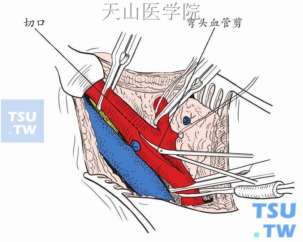 颈总动脉外侧纵形切开颈动脉