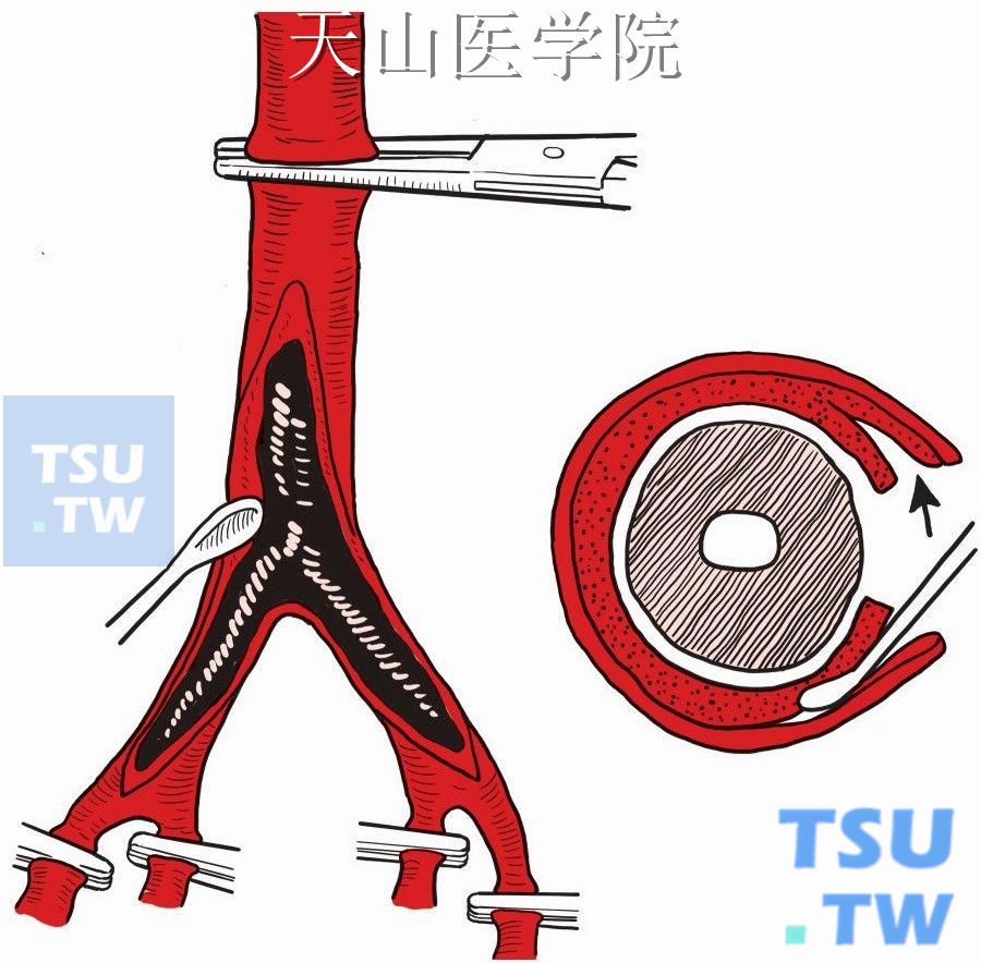 钝性刮匙剥离血栓和管壁中层