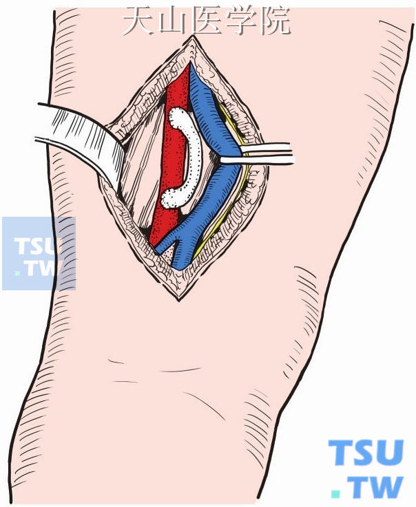 人造血管在闭塞血管两端搭桥转流