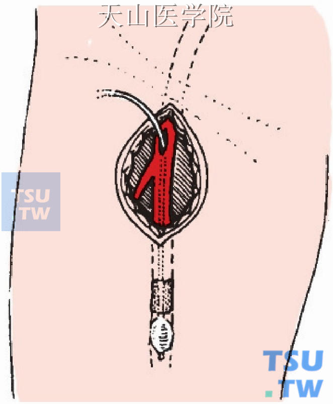 导管插入远侧动脉主干取栓