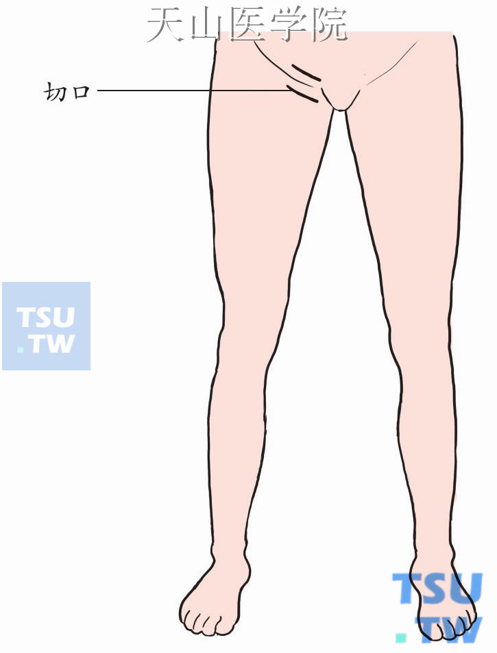 一般取腹股沟皮肤皱纹上方或者下方斜形平行切口，外侧为股动脉搏动处