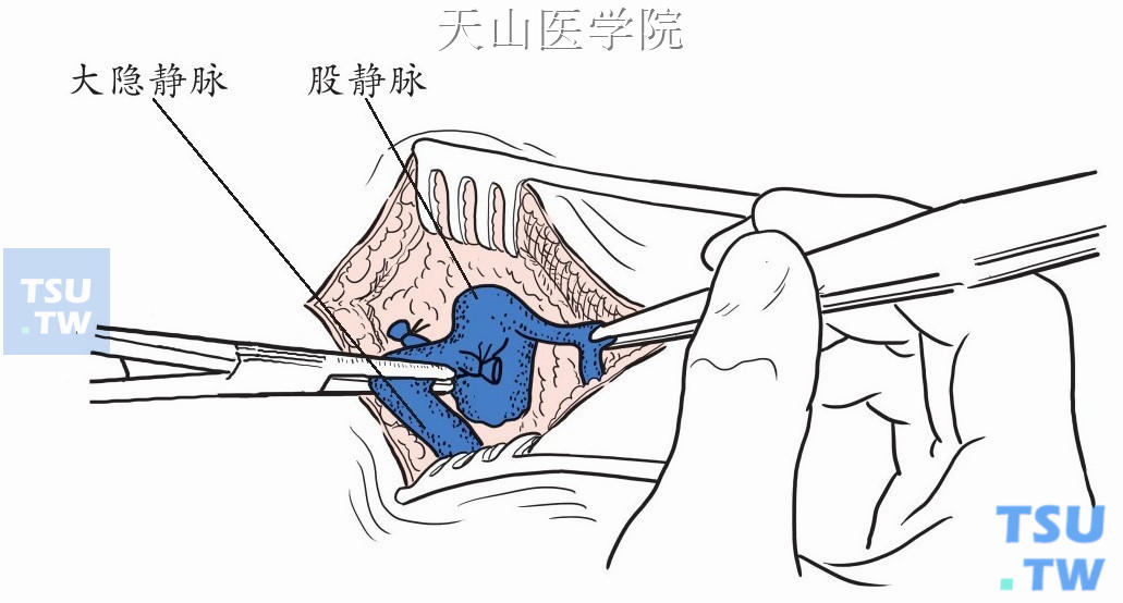 解剖大隐静脉主干到卵圆窝汇入股静脉处