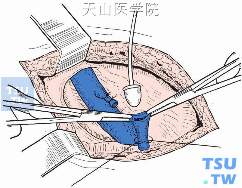 切断大隐静脉，近心端双道结扎，远心端插入剥脱器