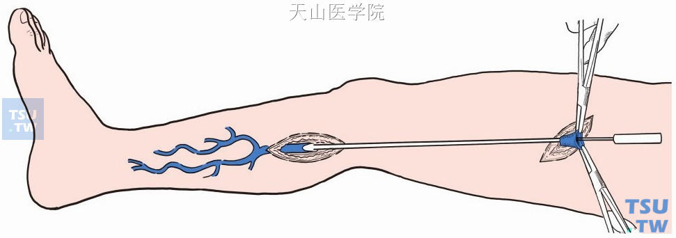 剥脱器插至膝关节下方做一切口，显露、切断、缝扎并固定静脉主干于剥脱器上，向上剥脱大隐静脉主干