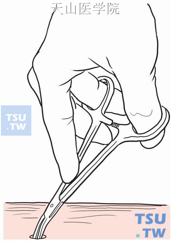 皮肤小切口，小血管钳钳夹曲张大隐静脉