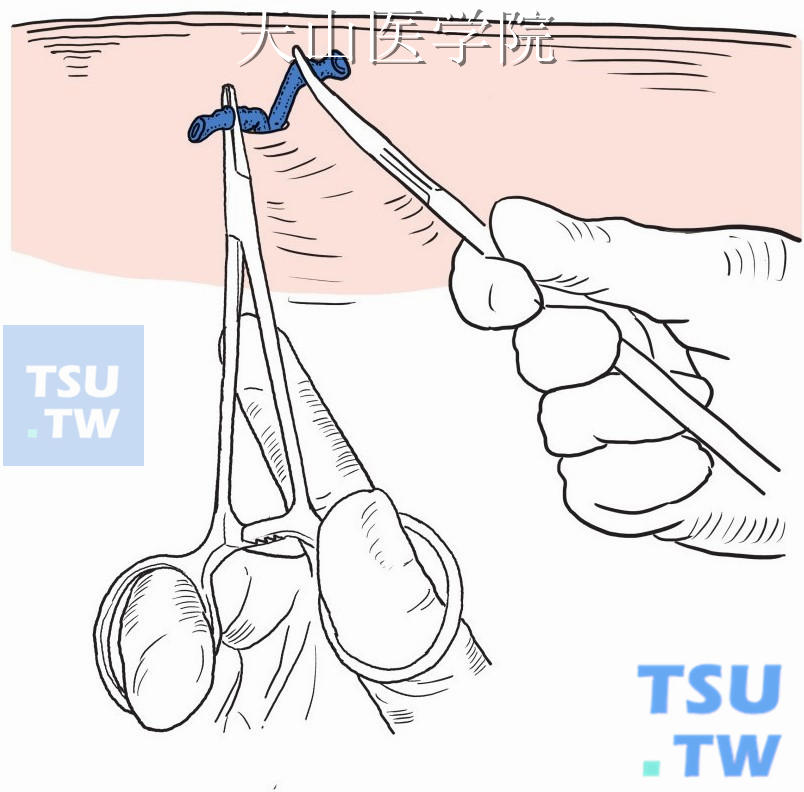 将静脉拉出切口，分别钳夹近、远端静脉