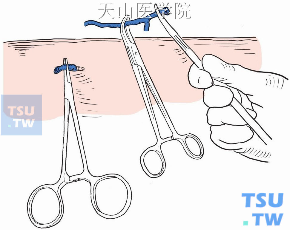 用力拉出局部的近、远端静脉