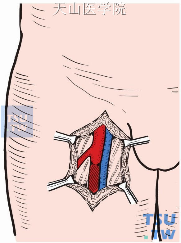 显露股总、股浅和股深动脉，并确定闭塞的平面