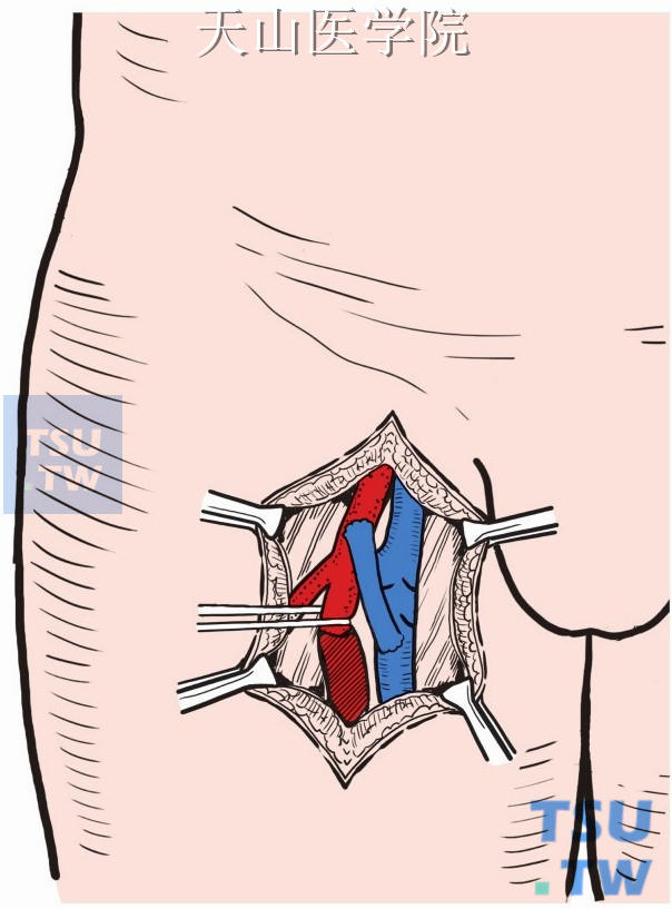 动脉闭塞近侧通畅段与正常处做动脉转流口