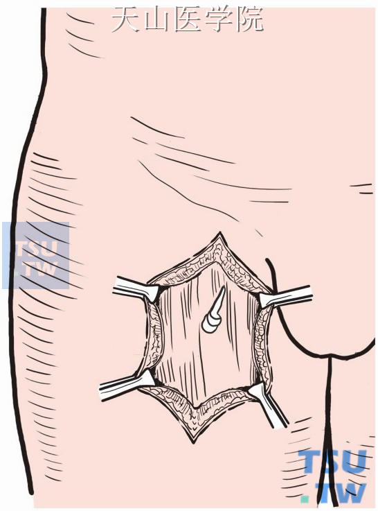 取1号尼龙线一根，在静脉转流口近侧1cm处宽松地环绕股浅静脉两周，将两根线头套入一根细硅胶管内（长度为该静脉至皮下组织的距离），防止尼龙线与邻近组织粘连